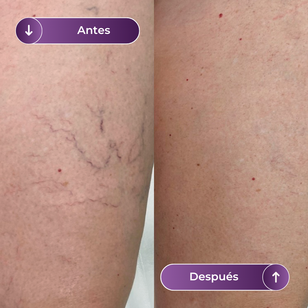 VARISENS - LOCIÓN DE PIERNAS - AUREVA