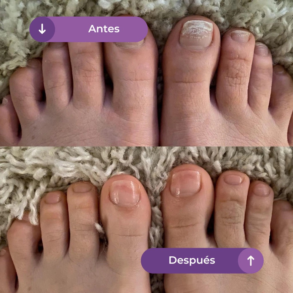 FUNGIVEX: El aceite que elimina el 99.9% de los hongos en tus uñas.