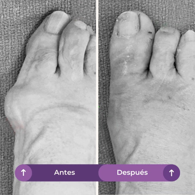 KIT ANTI BUNION ORTOPEDICO