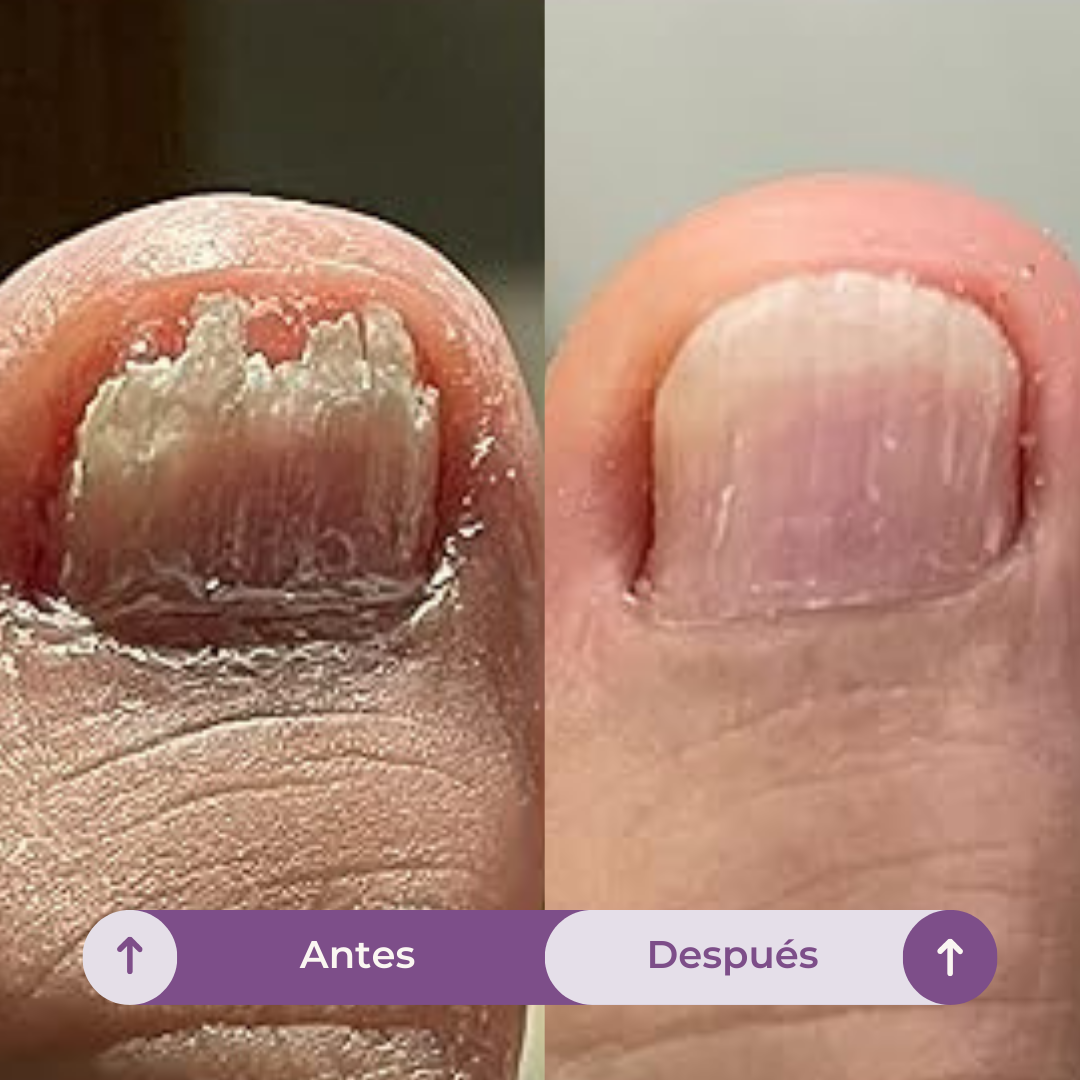 FUNGUVEX: El aceite que elimina el 99.9% de los hongos en tus uñas.