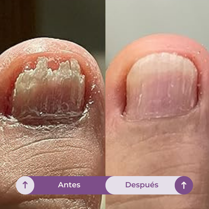 FUNGUVEX: El aceite que elimina el 99.9% de los hongos en tus uñas.