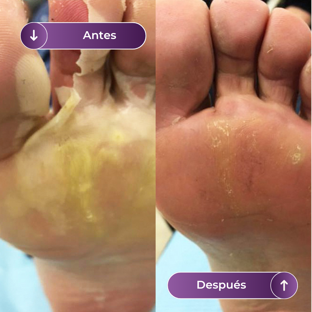 CALLONIL - REMOVEDOR DE CALLOS - AUREVA