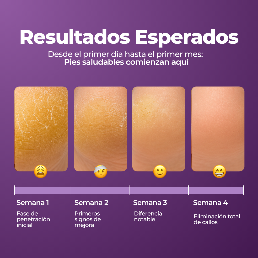 CALLONIL - REMOVEDOR DE CALLOS - AUREVA