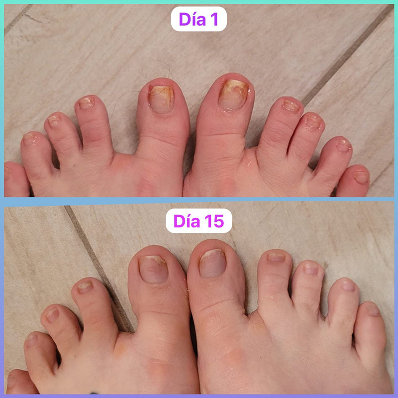 Antes y después real de una clienta de FUNGUVEX: uñas del día 1 comparadas con el día 15 de tratamiento