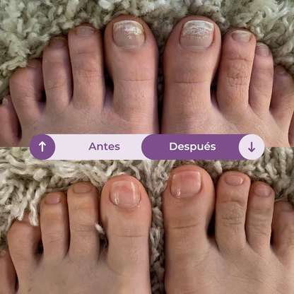 FUNGUVEX: El aceite que elimina el 99.9% de los hongos en tus uñas.
