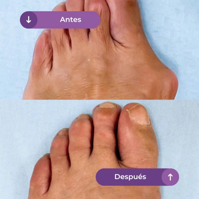 BUNION PRO CORRECTOR BALOX (2 UNIDADES)