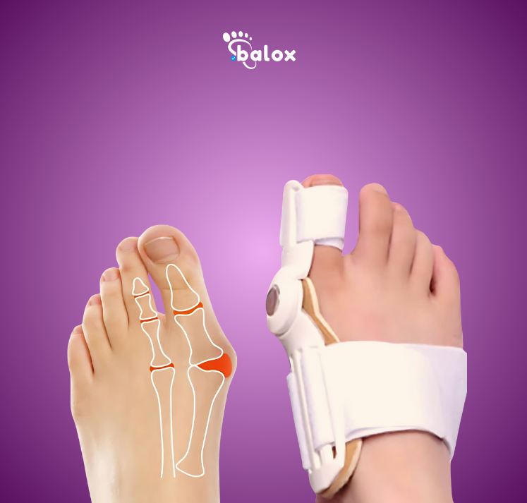 Hallux Valgus corrector PRO